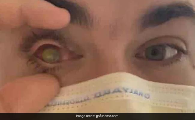 Man Sleeps With Contact Lenses On, Flesh-Eating Parasites Eat His Eye
